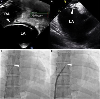 Long-term clinical outcomes for patients with uncrossable patent foramen ovale